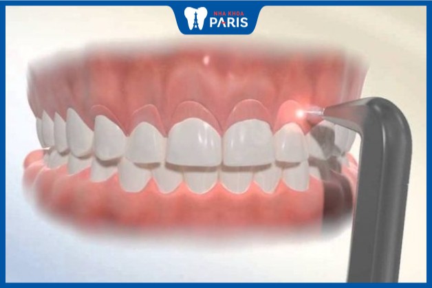Những trường hợp nên cắt lợi để cải thiện sức khỏe răng miệng